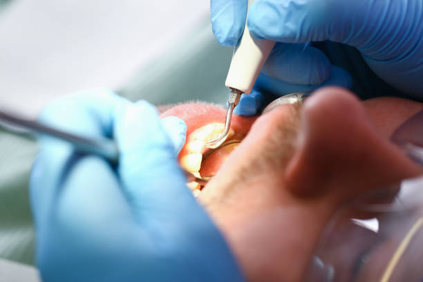 Best Emergency Dental Care for Broken or Chipped Teeth in San Carlos, TX
