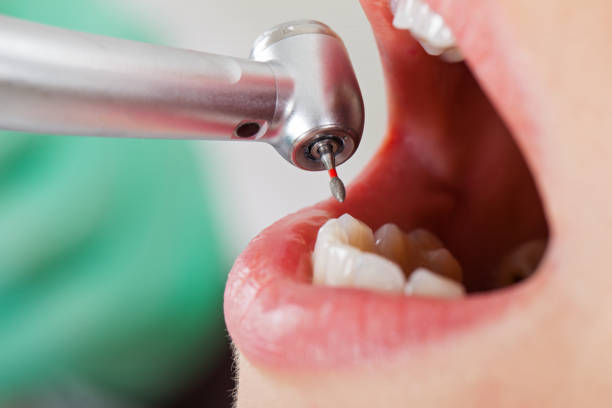 Best Emergency Wisdom Teeth Removal in San Carlos, TX